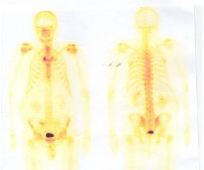 Scintigrafie skeletu
